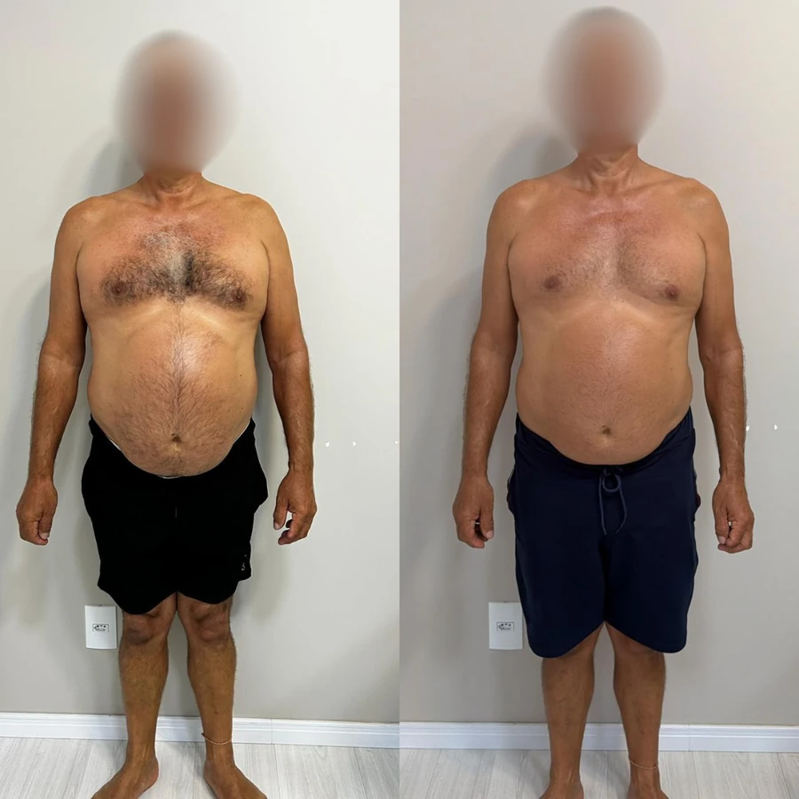 Antes e Depois - Paciente 1