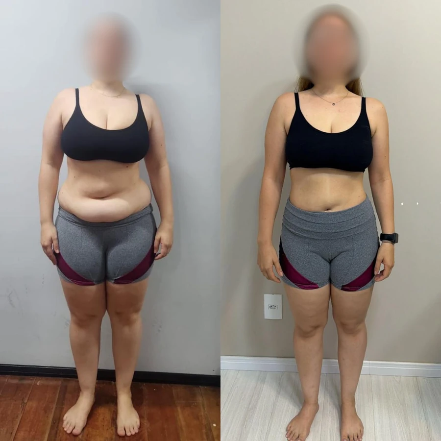 Antes e Depois - Paciente 2