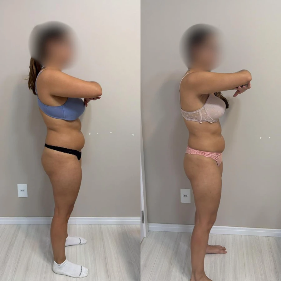 Antes e Depois - Paciente 3