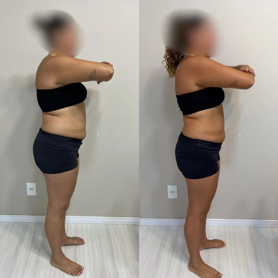 Antes e Depois - Paciente 4