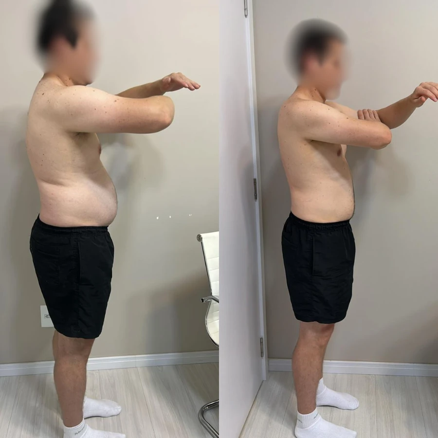 Antes e Depois - Paciente 5