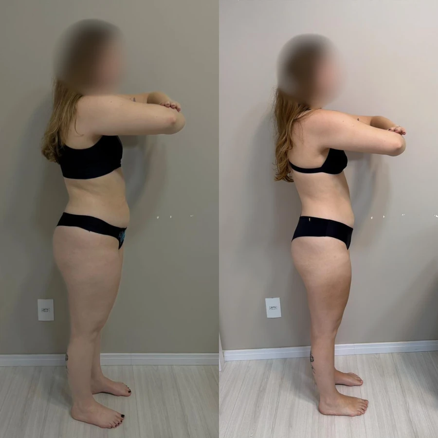 Antes e Depois - Paciente 6